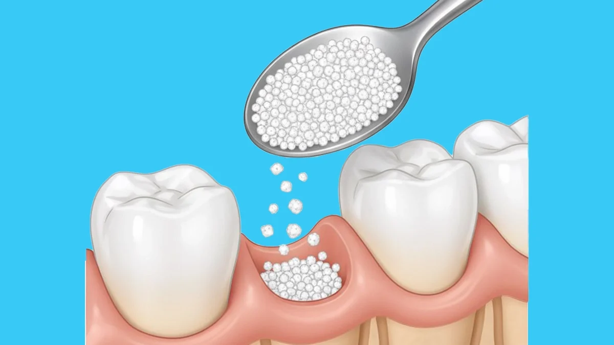 Types of Bone Grafts and Membranes in Dental Implantology